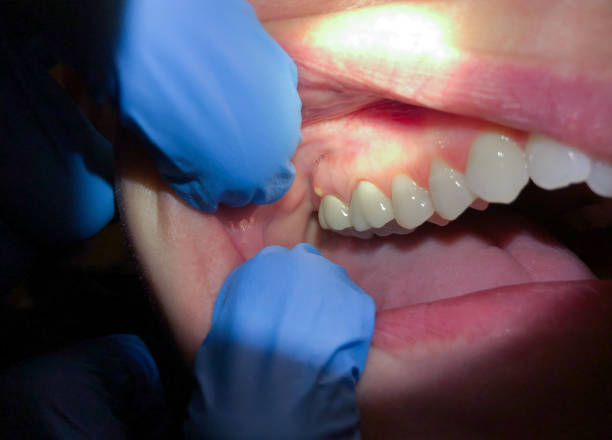 Best Emergency Root Canal Treatment in Chinook, MT